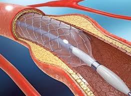 Angioplastie Coronaire